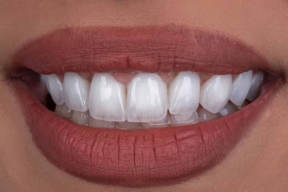 Smile transformation 9