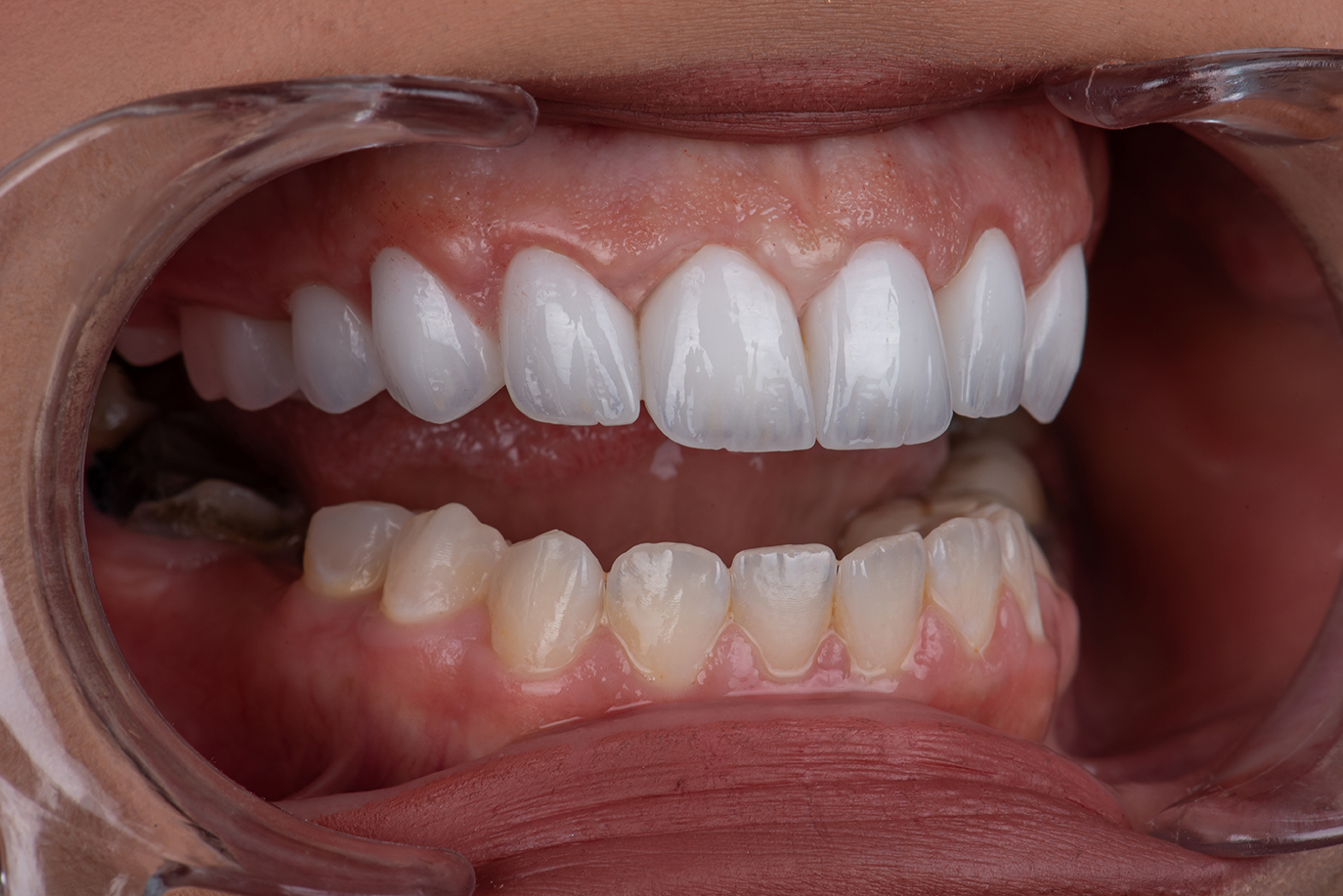 Smile transformation 10