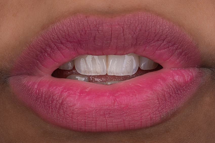 Smile transformation 11