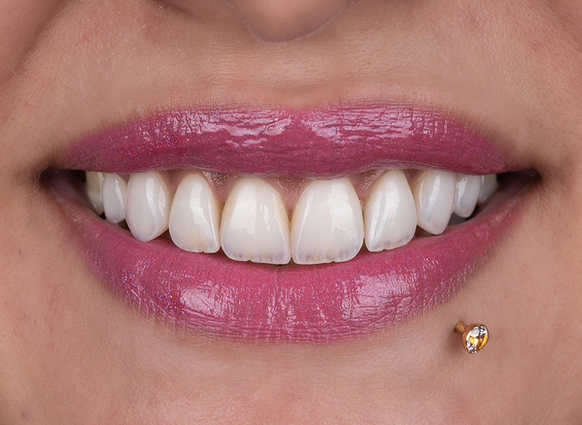 Smile transformation 13