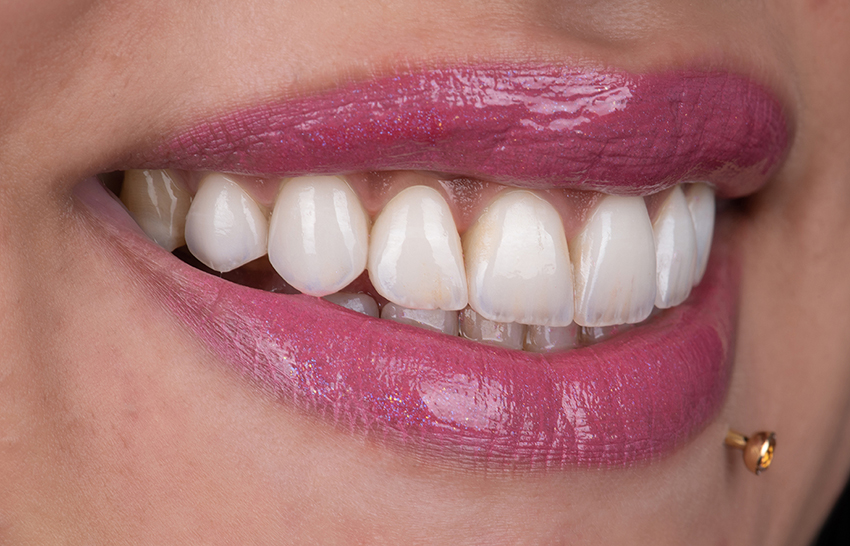 Smile transformation 14