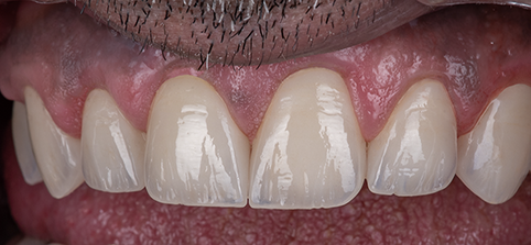 Smile transformation 15