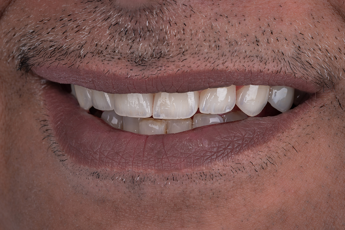 Smile transformation 16