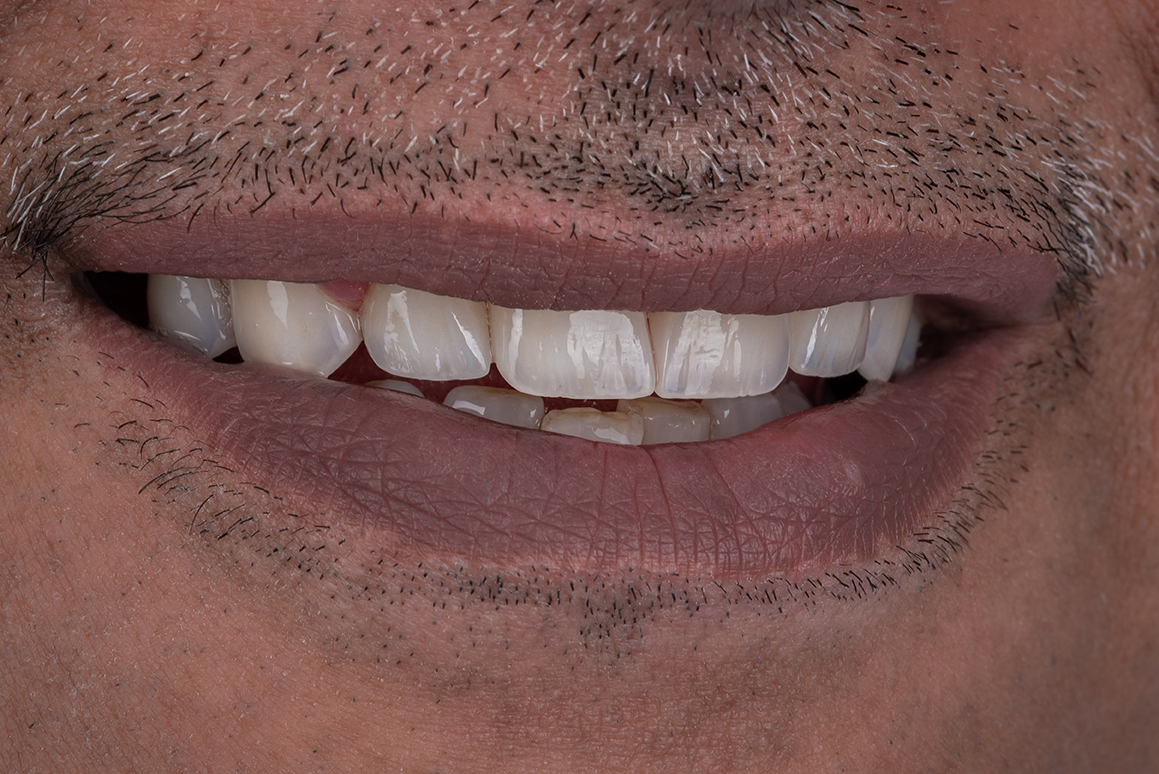 Smile transformation 17