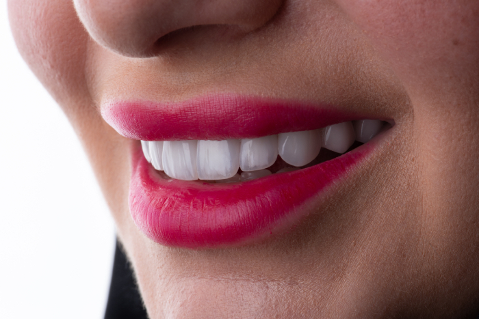 Smile transformation 3