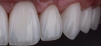 Smile transformation 4