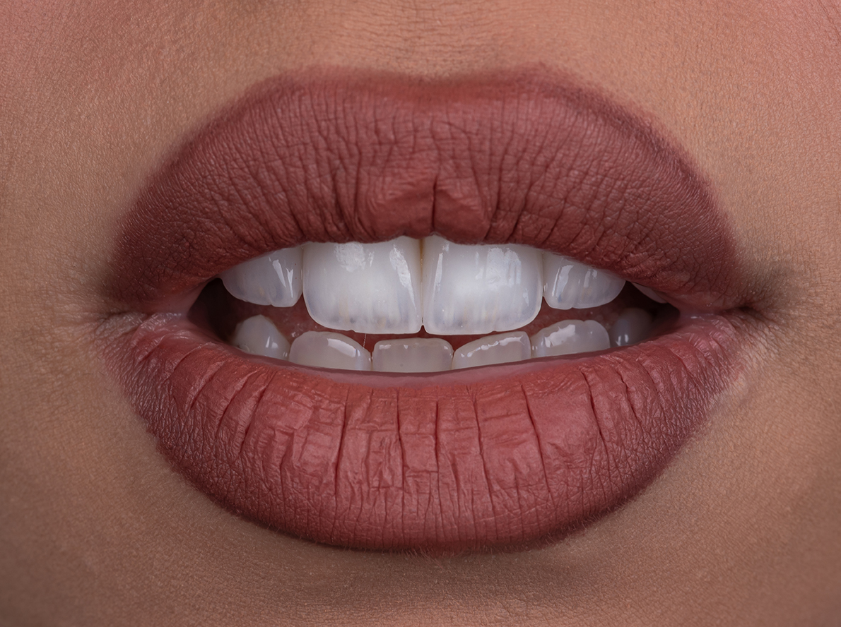 Smile transformation 5