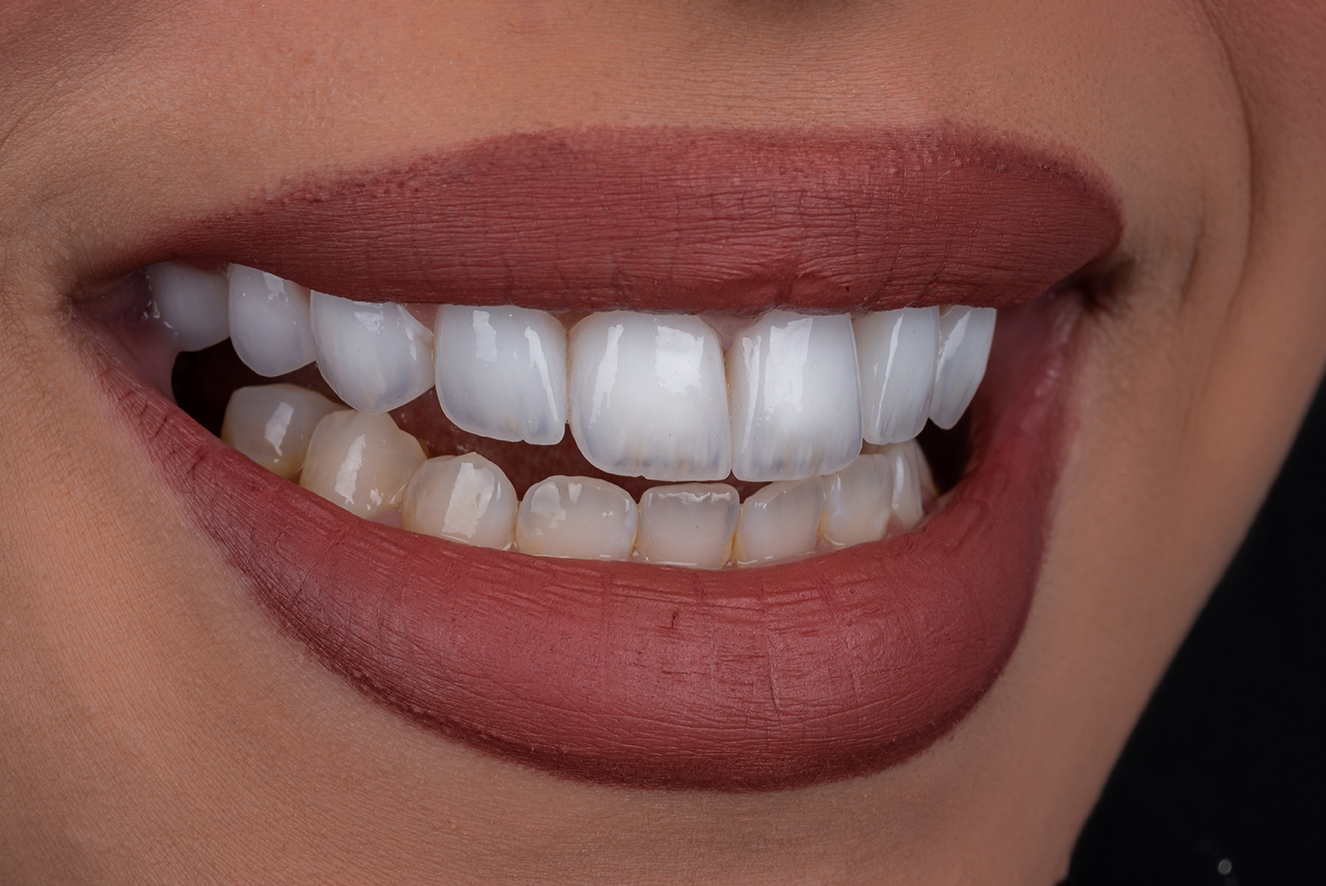 Smile transformation 6