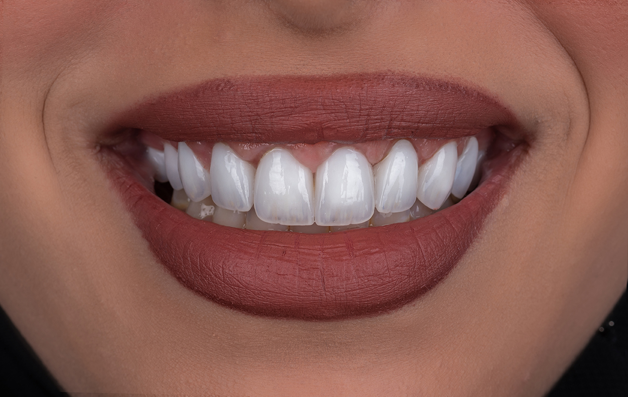 Smile transformation 8