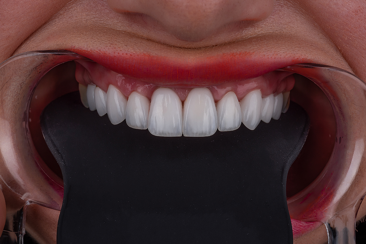 Smile transformation 20